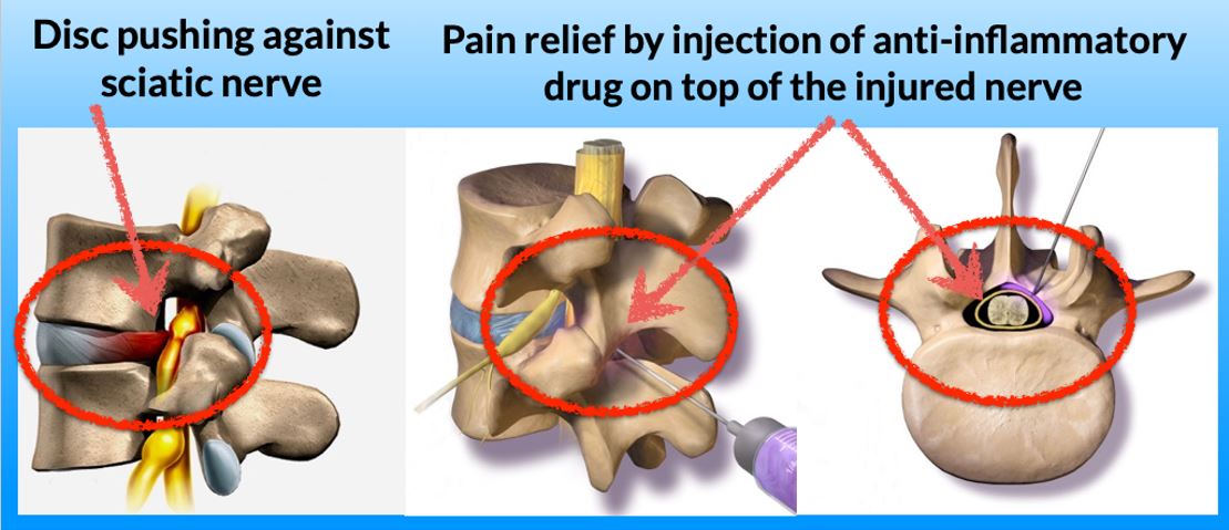 epidurals-interventional-pain-management-center