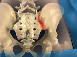 What about Sacroiliac Joint Pain and Injection?